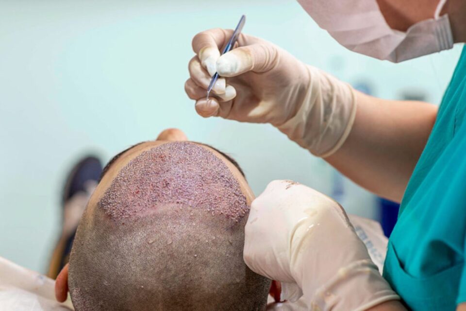 The Truth About Hair Transplants